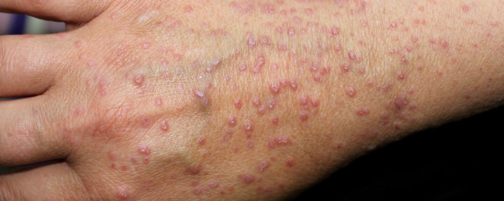 Lichen Planus Causes, Symptoms and Homeopathy Treatment