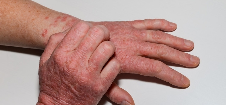 Skin Problem_ How psoriasis and eczema are different from each other