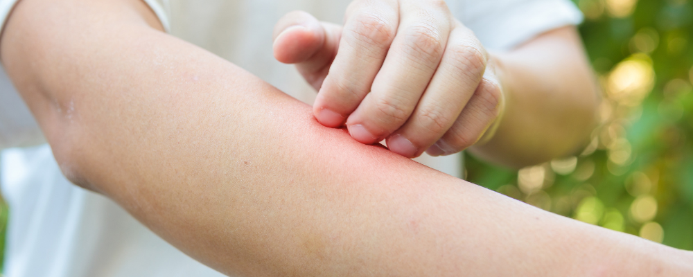 types of skin allergies and common sources