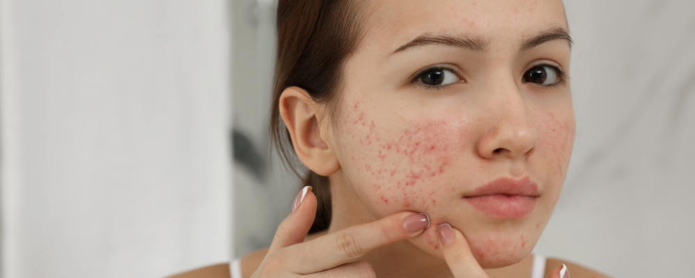 Acne scar Treatment with Homeopathy
