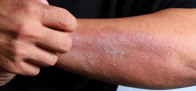 How can homeopathy medications overcome the impact of eczema