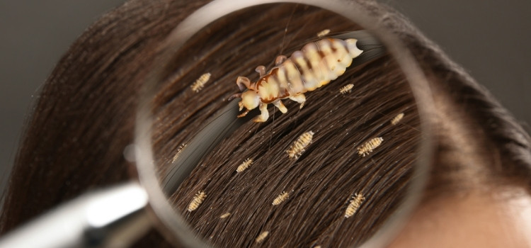 How to eliminate head lice using effective homeopathic remedies