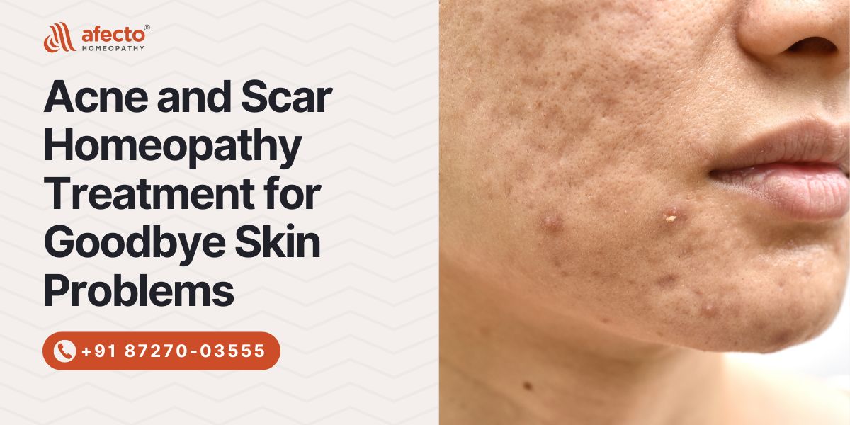 Acne and scar homeopathy Treatment