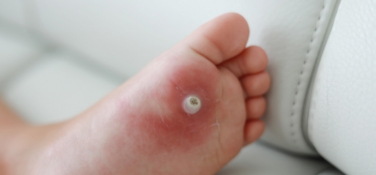 All you need to Know about Warts and its treatment