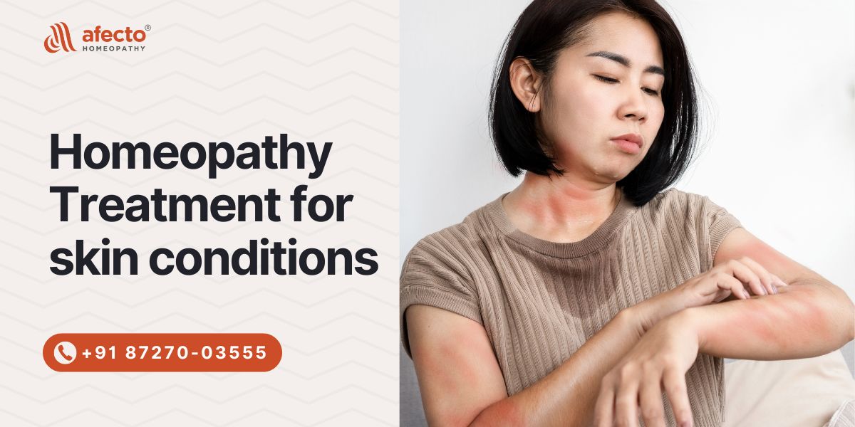 Homeopathy Treatment for skin conditions