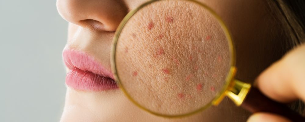 Best Home Remedies Acne and Pimples 