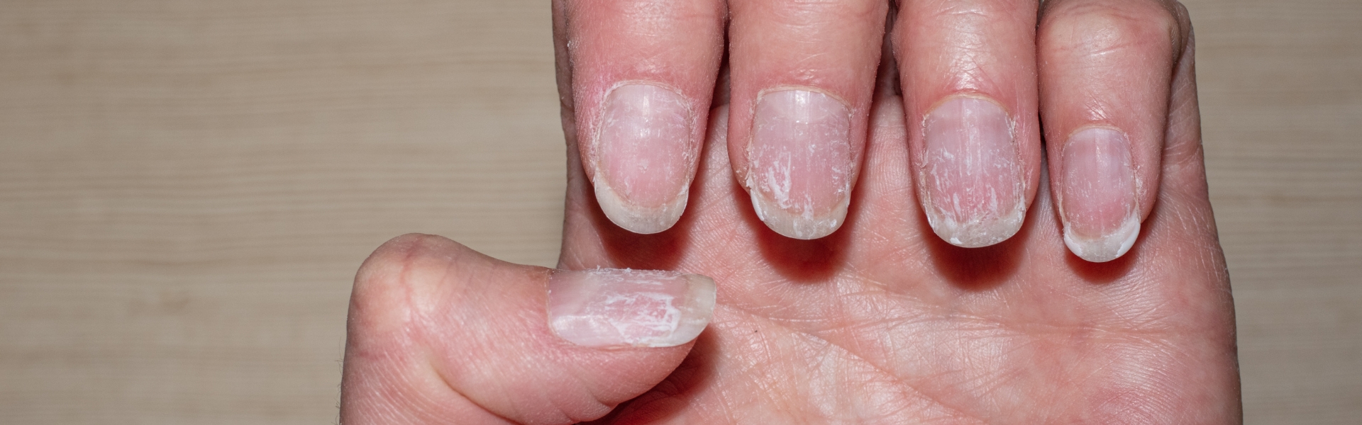 Brittle Nails Treatment in homeopathy