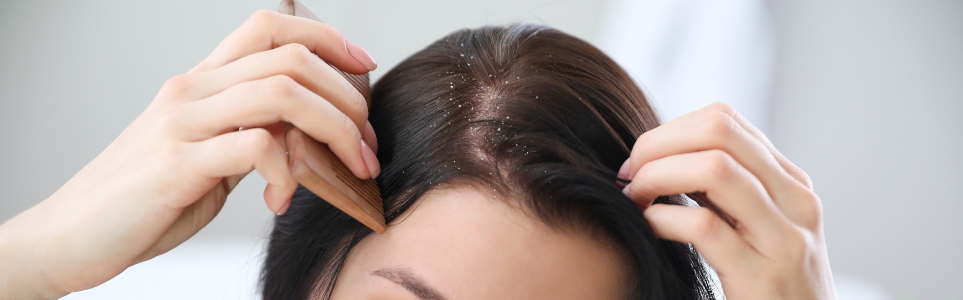 best homeopathy treatment for Dandruff