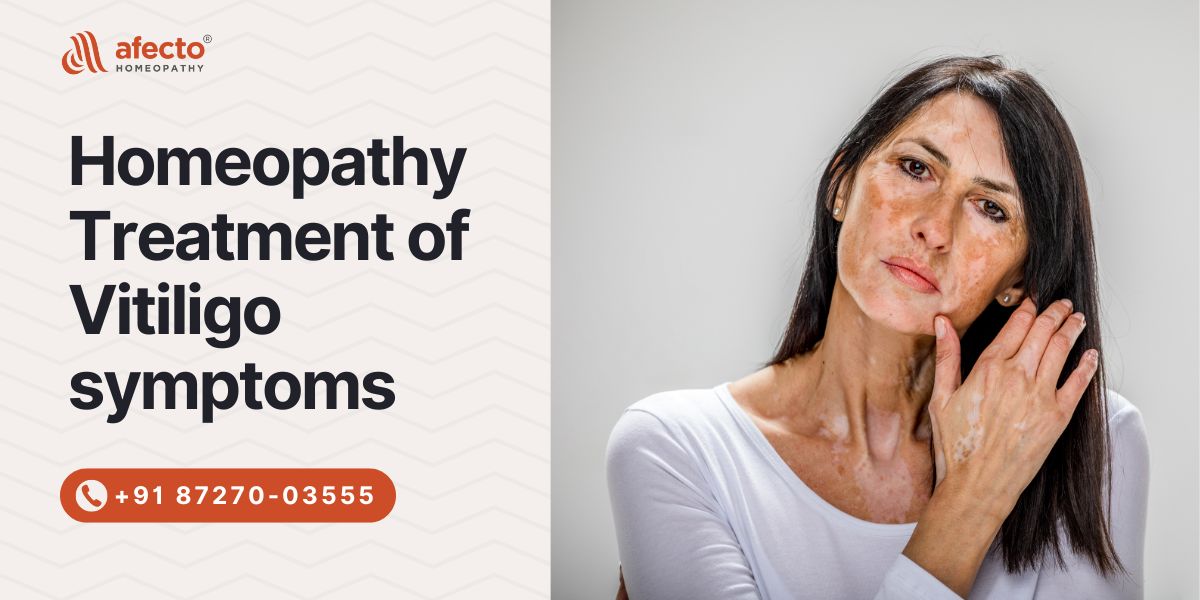 Homeopathy Treatment of Vitiligo symptoms