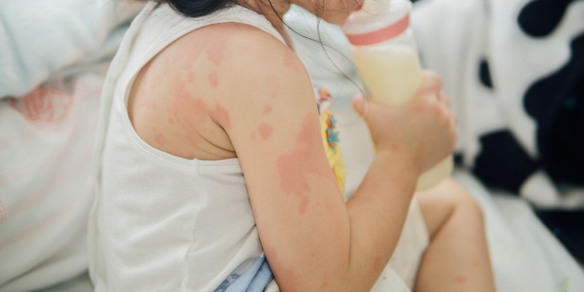 Indian Home Remedies For Skin Allergy