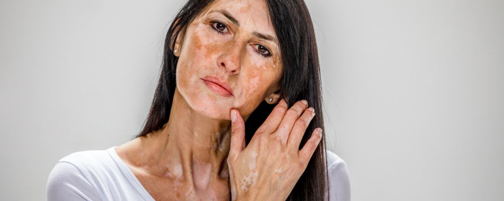 Homeopathy Treatment of Vitiligo symptoms