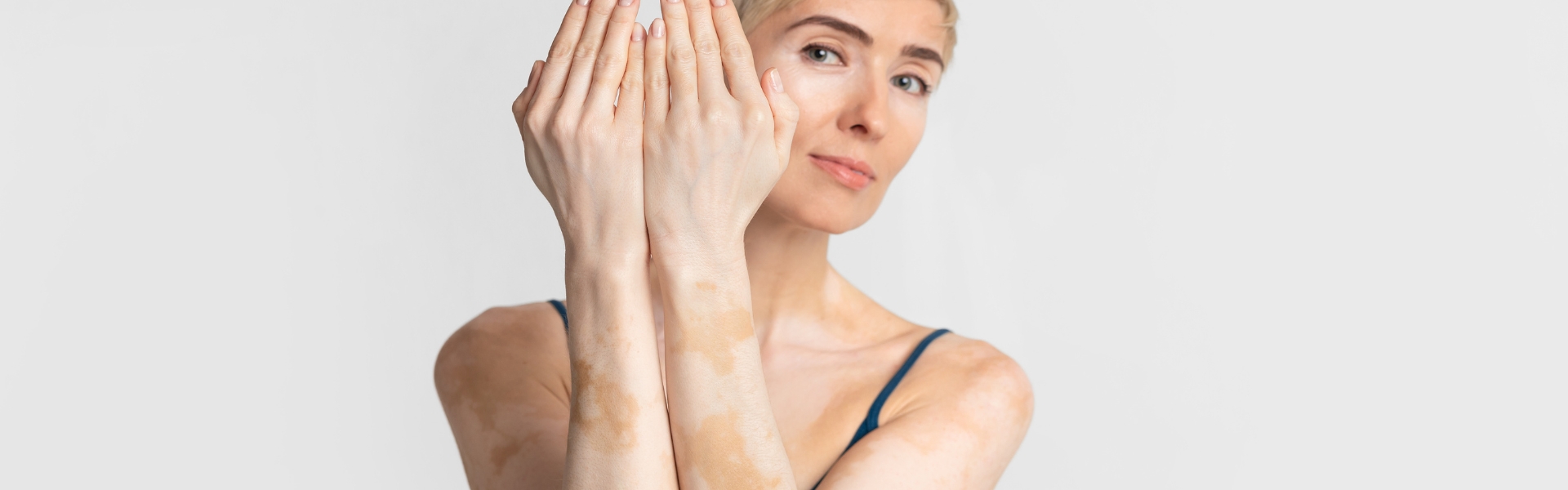 Vitiligo Treatment in Homeopathy