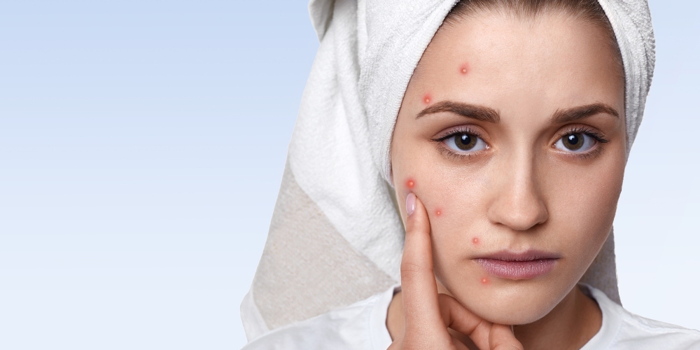 Home Remedies for Acne