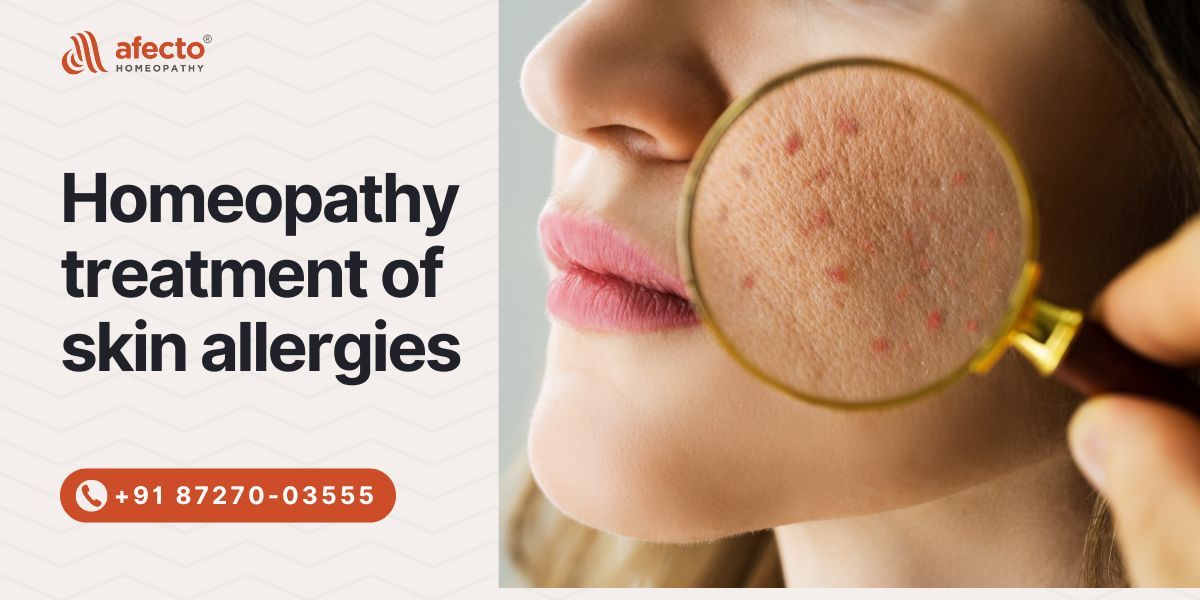 Homeopathy treatment of skin allergies