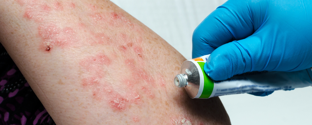 Psoriasis: Symptoms, Causes and homeopathy Treatment