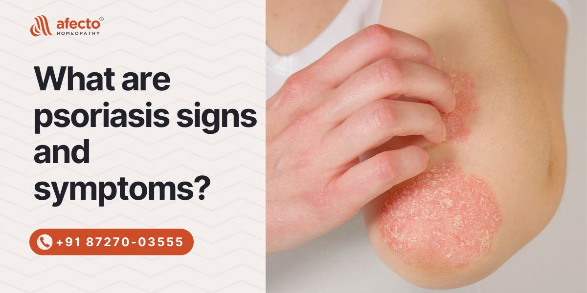 psoriasis signs and symptoms