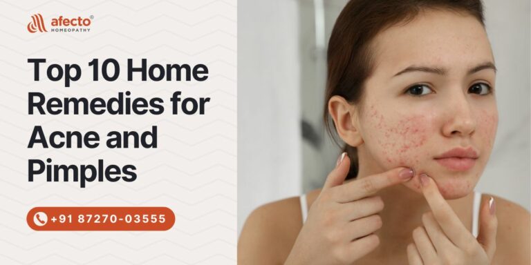 home remedies for acne and pimples