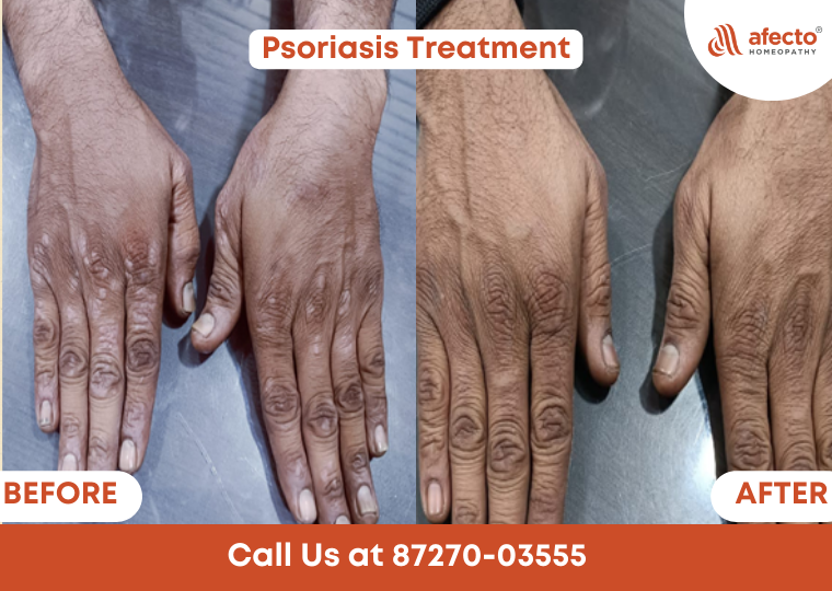 Psoriasis homeopathy Treatment
