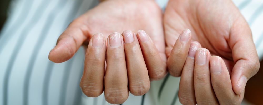 Suffering From Onychoschizia or Brittle Nails?