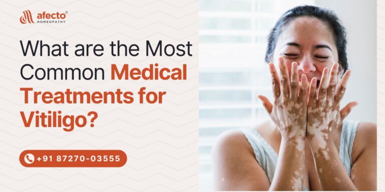 What are the Most Common Medical Treatments for Vitiligo?