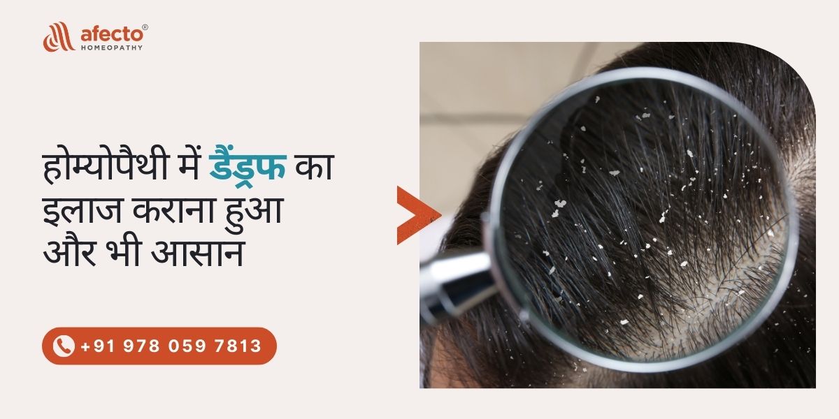 Dandruff Treatment in Homeopathy