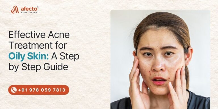 Effective Acne Treatment for Oily Skin A Step-by-Step Guide