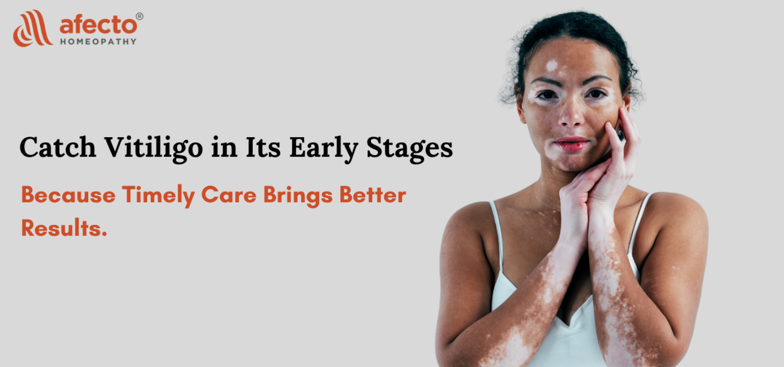 How to detect vitiligo