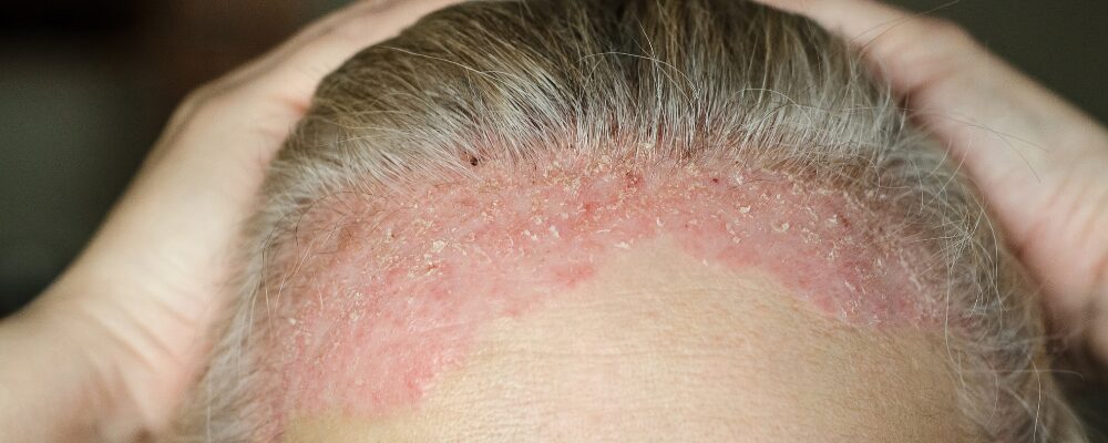 Understanding Psoriasis