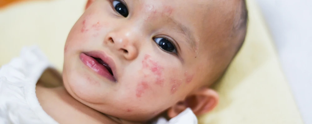 children affected by seasonal allergy