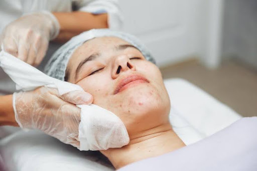 Acne Treatment